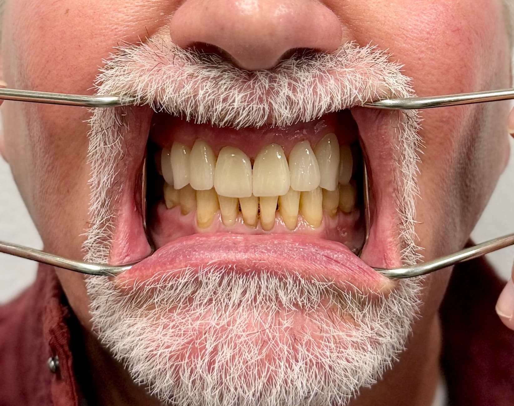 Patient smile after 3D printed veneers treatment