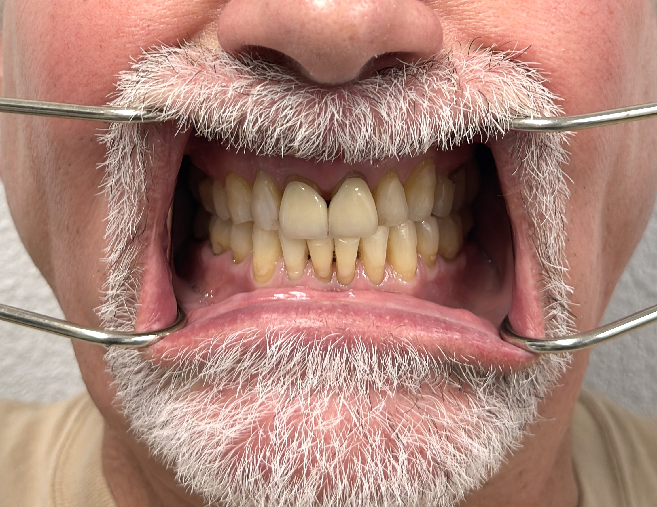 Before 3D Printed Veneers