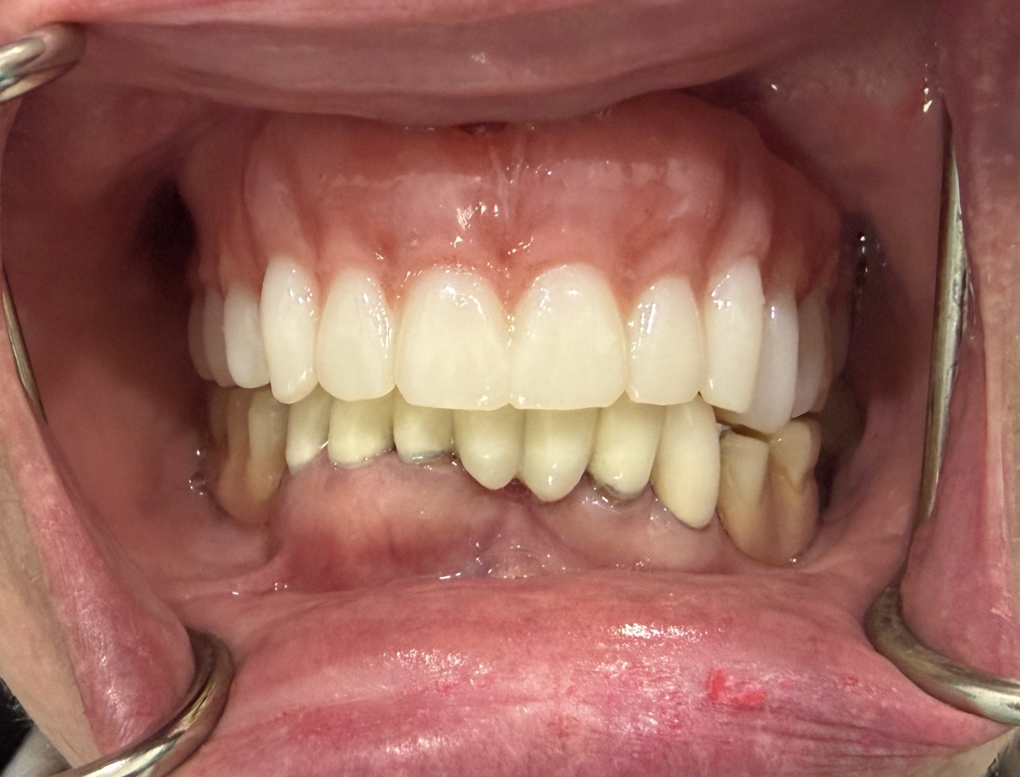 After 3D Printed Dentures