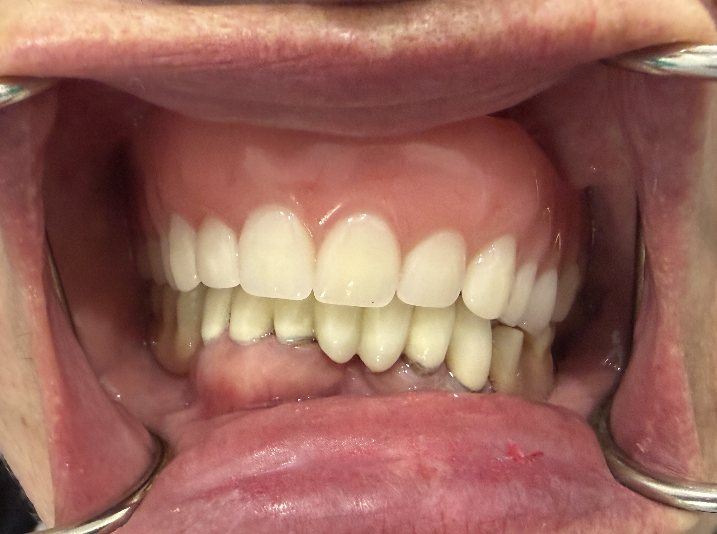 Before 3D Printed Dentures